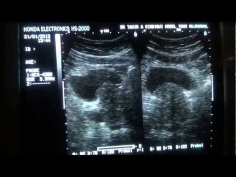 Vergrößerte Prostata-Drüsen Tinktur der chronischen Prostatitis