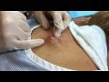 Infected Cyst on Mid-back