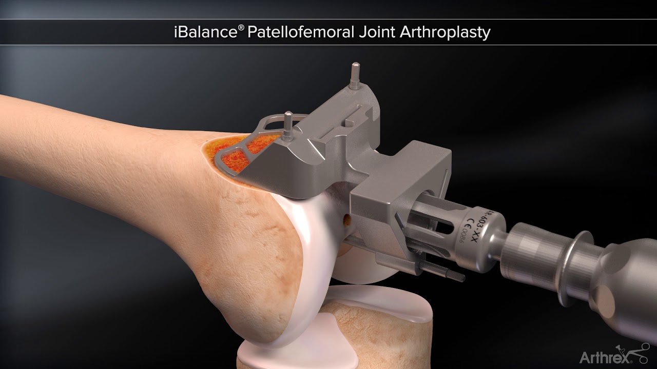 iBalance® Patellofemoral Joint Arthroplasty