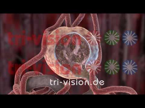 Diabetisches Koma mit Typ-2-Diabetes Rauchen erhöht Insulin