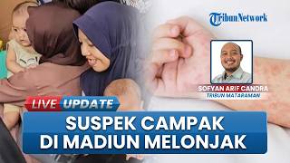 Madiun Siaga KLB, Kasus Suspek Campak Melonjak 100 Persen, Dinkes Tunggu Hasil Laboratorium