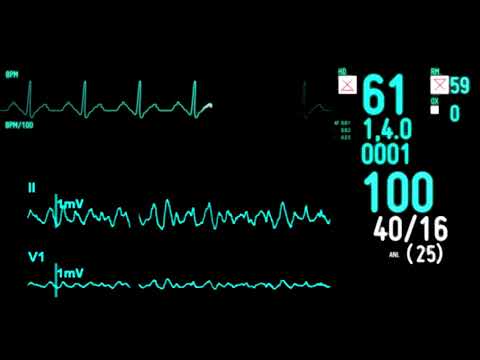 ECG monitor Экг монитор футаж Пульс сердца