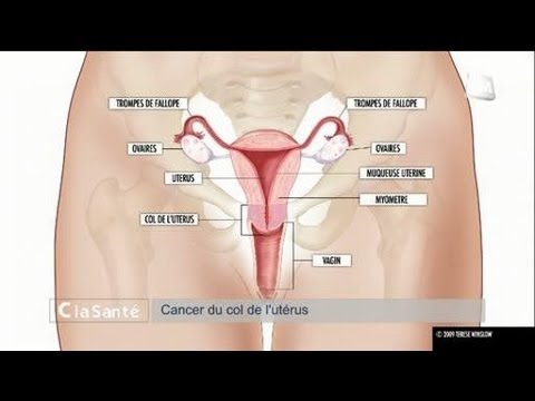comment guerir le cancer du col de l'uterus