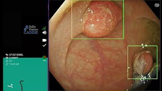 CADDIE - compatible with Olympus's latest EVIS X1 Endoscopy system