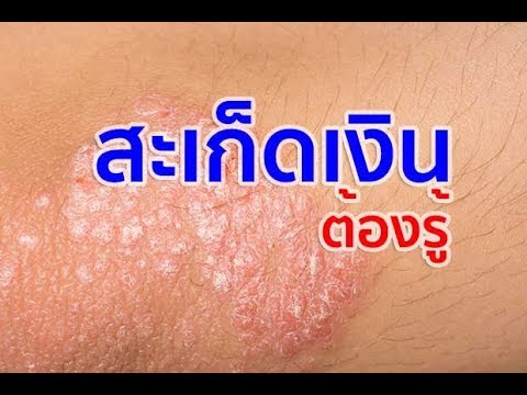 รูปภาพของกลากบนใบหน้า เศษชุดโรคสะเก็ดเงิน