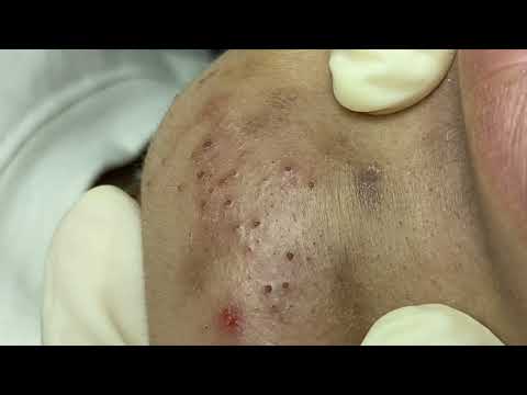 Big Blackheads