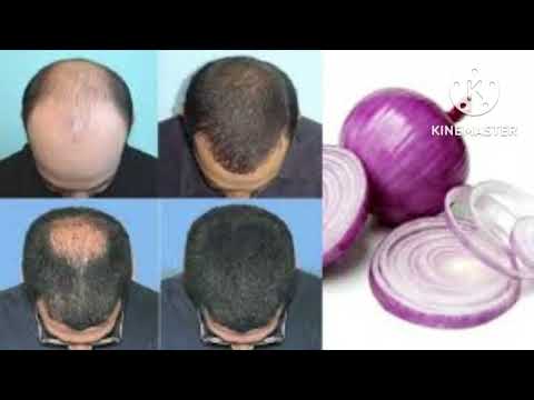 onion juice for hair/biyaha basasha mexey utaraan timaha