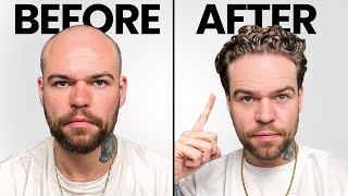 I Got A Turkish Hair Transplant! Before, During and After