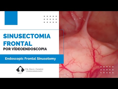 Miniatura: Sinusectomia Frontal por Vídeoendoscopia