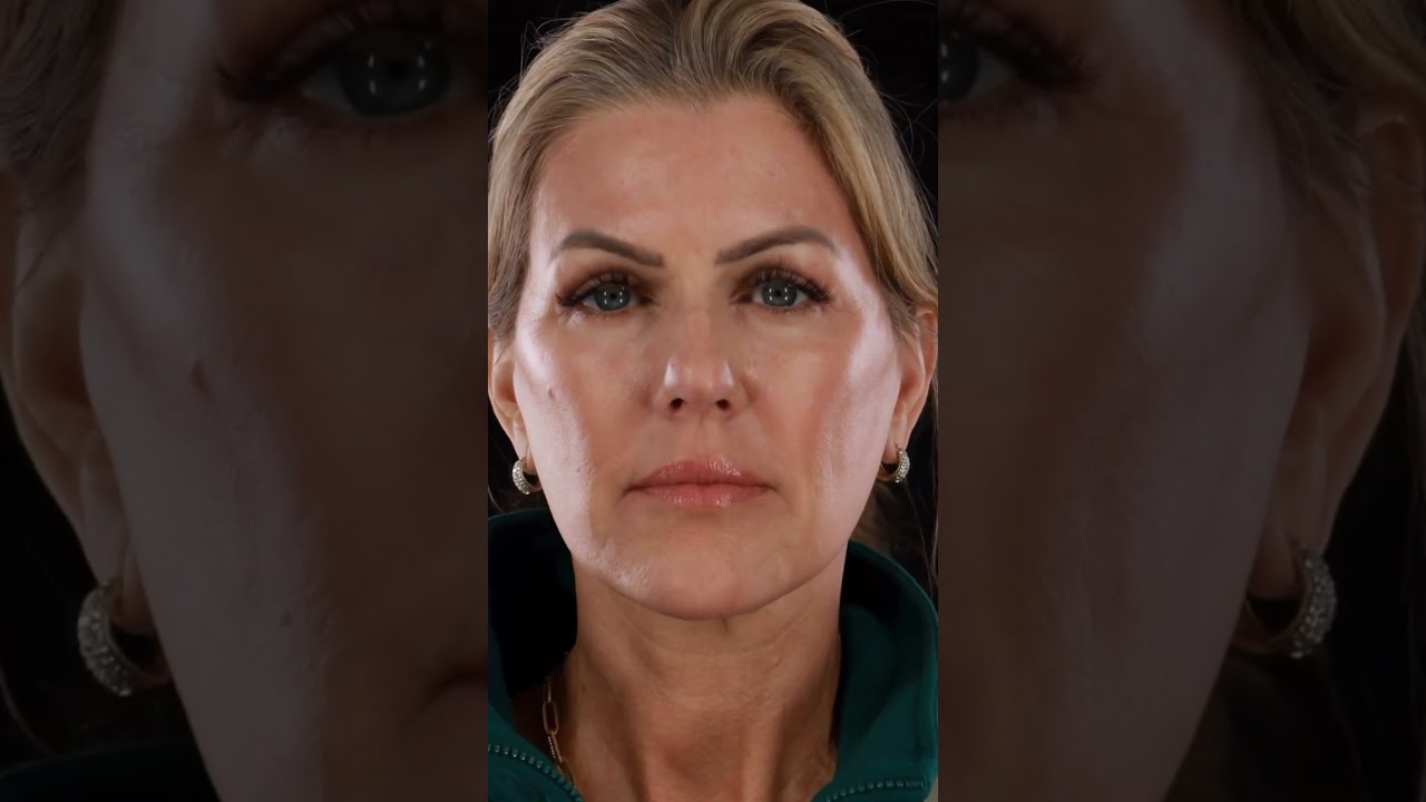 Introducing the Phoenix Lift™  at Vivify Plastic Surgery