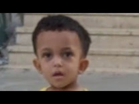 Case 613 Achondroplasia, skeletal dysplasia،AD ,FGF3,paternal, Dwarfism, hydrocephalus, Hypotonia