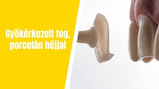 Gyökérkezelt fogra porcelán héj?