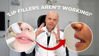 Lip Filler Alternatives For Thin Lips | Dr.Greg Bran