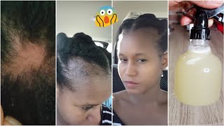 Best Homemade Remedy To Regrow Your Baldspots, Edges And Crown Area Naturally Stop Hair Fall