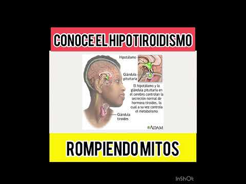 Conoce el hipotiroidismo