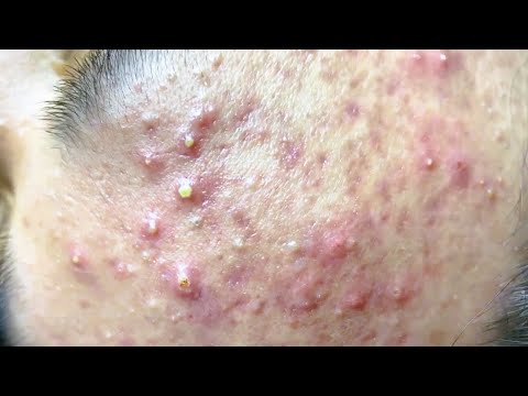 Removing Blackheads – Satisfying Pore Cleansing * ASMR Relaxation *
