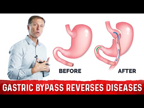 Can Diabetes Be Reversed – Dr Berg