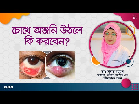 চোখে অঞ্জনির ব্যথা, কী করবেন। চোখ উঠলে কি করণীয়?
