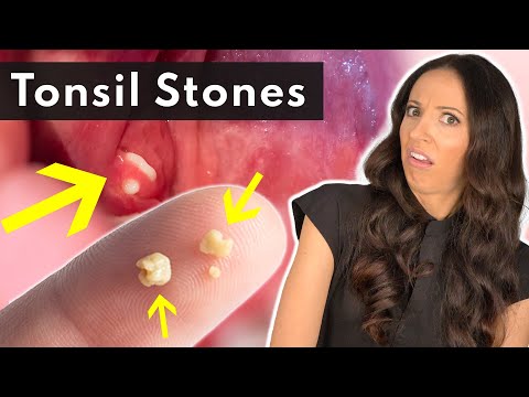 12 Ways To Get Rid Of Tonsil Stones At Home