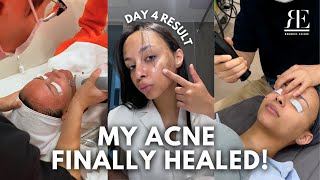My Korean Acne Removal Journey 🇰🇷 | Microcell + Dermablate Results