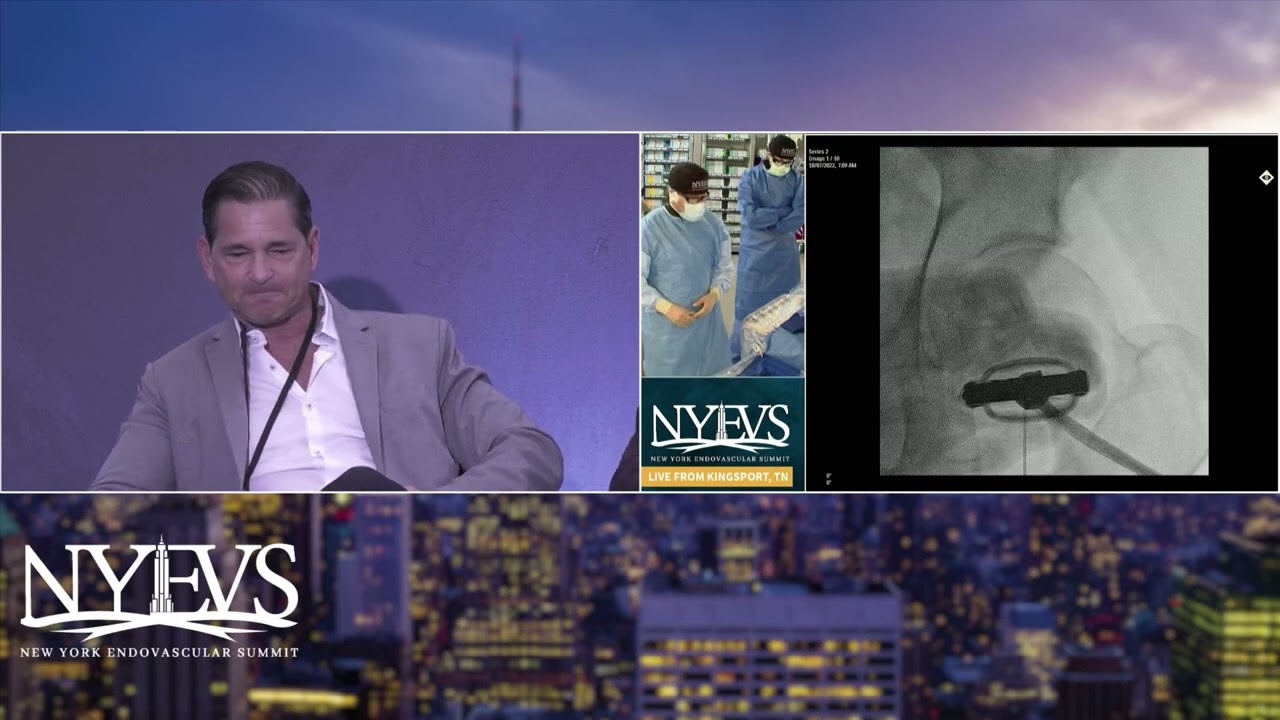 Live Case Presentation #1 Severely Calcific, Long Superficial Femoral Artery Cto Intervention   C  M