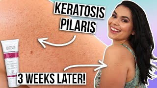 How I Treat My Keratosis Pilaris on Arms... NO MORE DRY BUMPY SKIN!