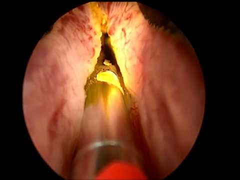 Prostata Prostata-Operation Preis Kraut lindert Entzündungen in der Prostata