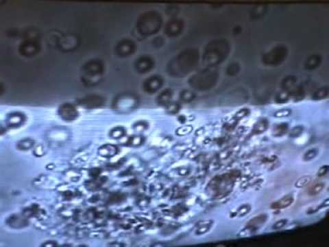 TRUS prostata Novosibirsk Il cancro alla prostata medicina cinese