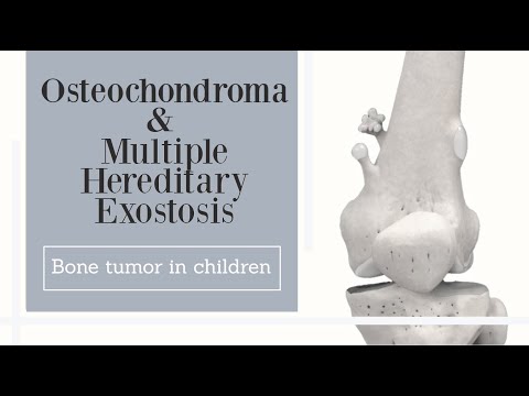 Osteochondrom und multiple hereditäre Exostose – Knochentumor bei Kindern (Untertitel)