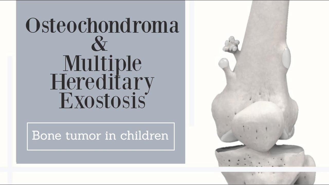 Osteochondroma & Multiple Hereditary Exostosis - bone tumor in children