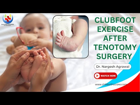 Clubfoot Exercise After Tenotomy Surgery ll tenotomy ll clubfoot exercises ll clubfoot ​⁠