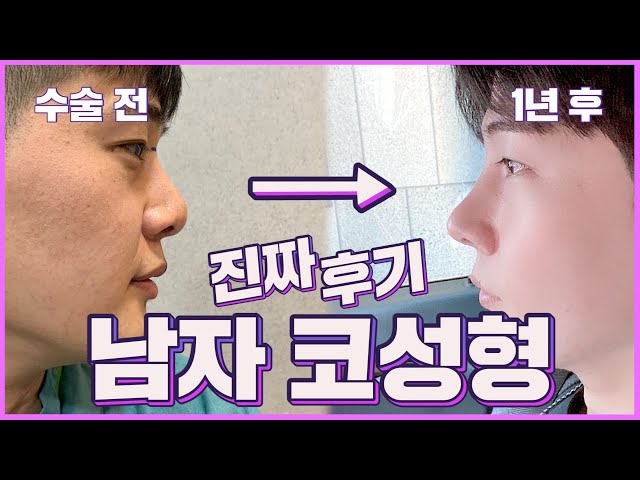에이비성형외과의원_코성형_낮은코 에이비성형외과의원_코성형_낮은코