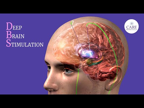 Deep Brain Stimulation Surgery Explained | How is DBS surgery done?