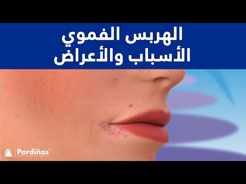 © الهربس الفموي – الأسباب والأعراض