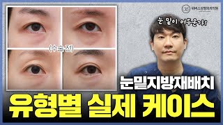 눈밑지방재배치 유형별케이스