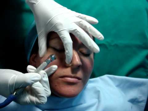 Peeling con diamantes, microdermoabrasión