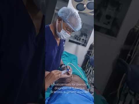 Amniocentesis@idealfertility 2