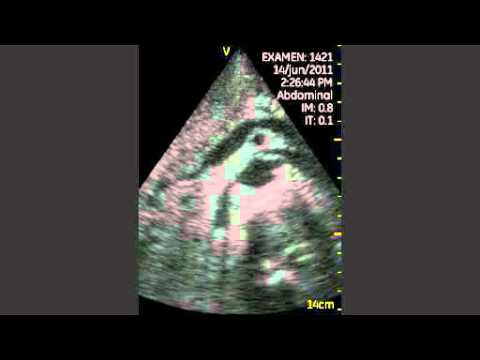 Chronic Pancreatitis - Pocket Ultrasound