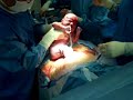 Cesarean Section Birth