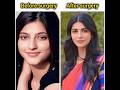 Bollywood Actresses Before Surgery Vs After Surgery Shruti Hassan Amy Jackson Viral Shorts