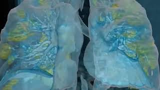 Download lagu Coronavirus: These are what COVID-19 infected lungs look like | ABC7 mp3