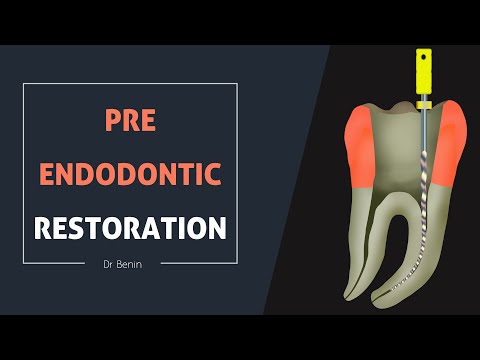 Odbudowa zęba przed leczeniem endodontycznym