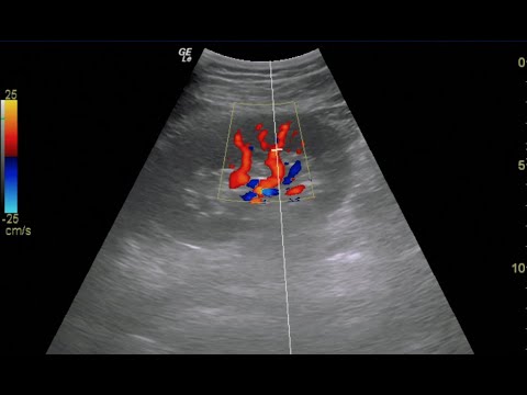 Renal Doppler Ultrasound