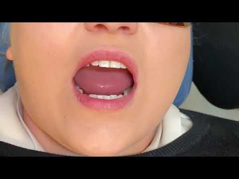 How to use an IPR strip