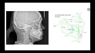 Case lâm sàng cắn ngược và lệch mặt được điều trị với MEAW