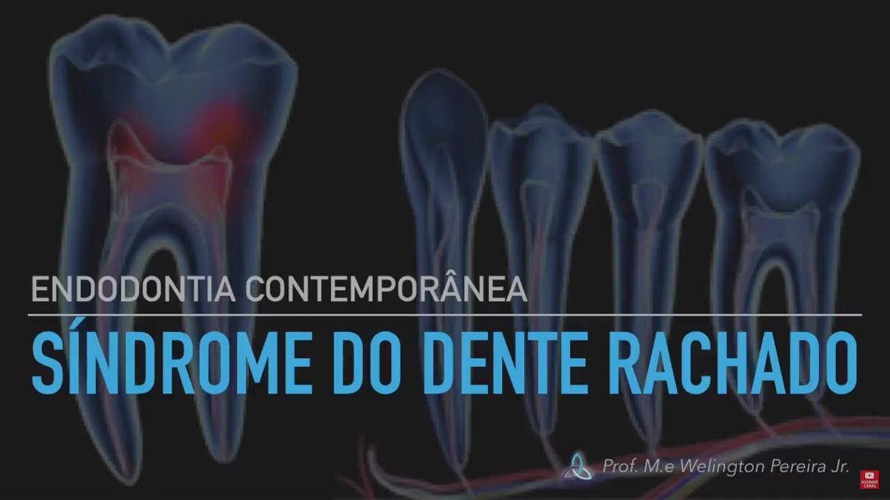 Síndrome do Dente Rachado