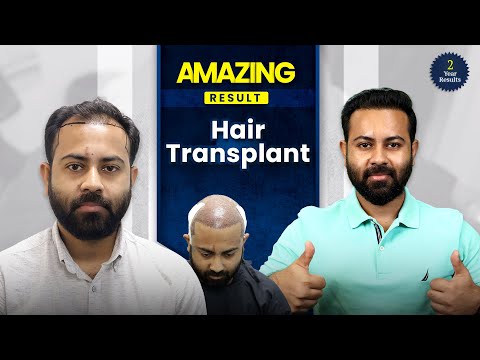 Massive Change in 2 Years | 4460 Grafts Hair Transplant Result | Grade 4 Transformation | Bangladesh