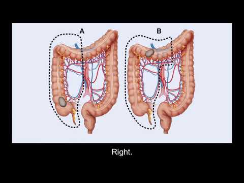 Surgery Treatment Options for Colorectal Cancer | Memorial Sloan Kettering