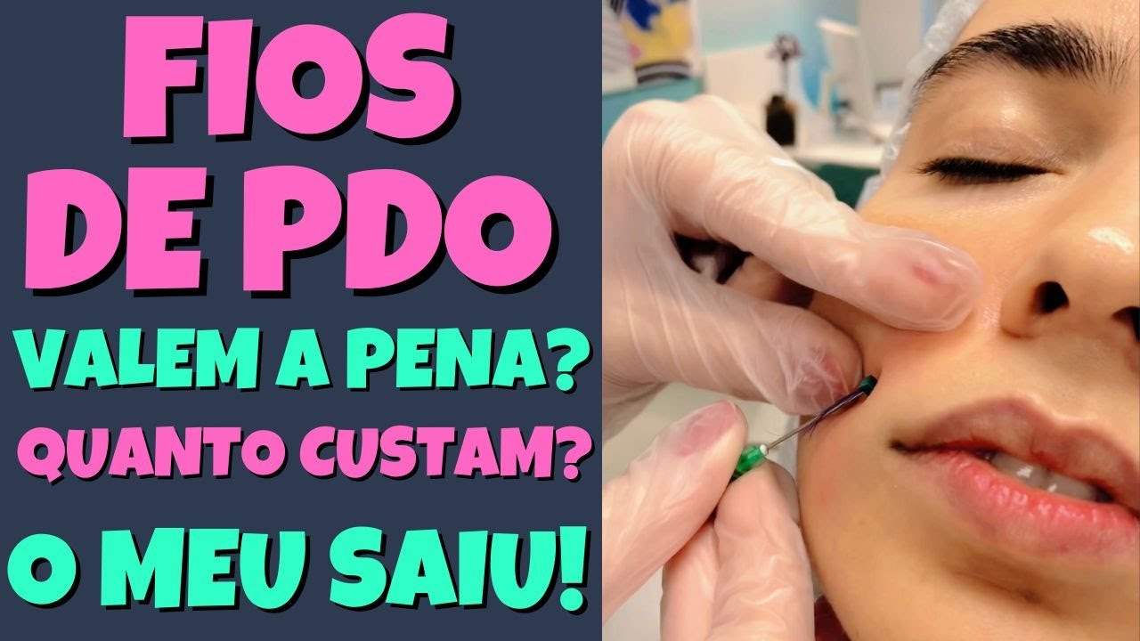 Watch Now Fios de PDO | Antes, depois, preço e o que aconteceu comigo Fios de PDO | Antes, depois, preço e o que aconteceu comigo