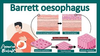 Barrett's oesophagus | esophageal adenocarcinoma | treatment and pathology | USMLE